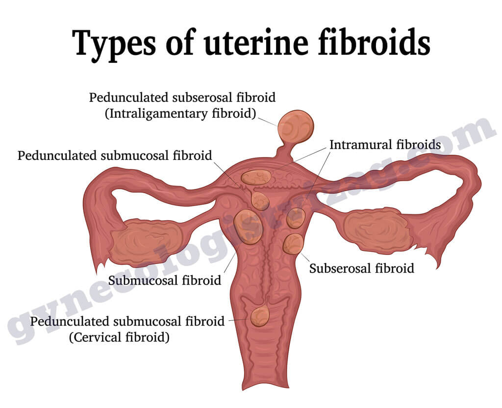 Types Of Uterine Fibroid and Uterine Fibroid Treatment